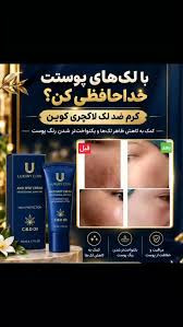 5 محصول موثر درمانی رفع لک و اکنه و جای جوش برند لاکچری کوین فرانسه مستقیم از نمایندگی ایران زمین
